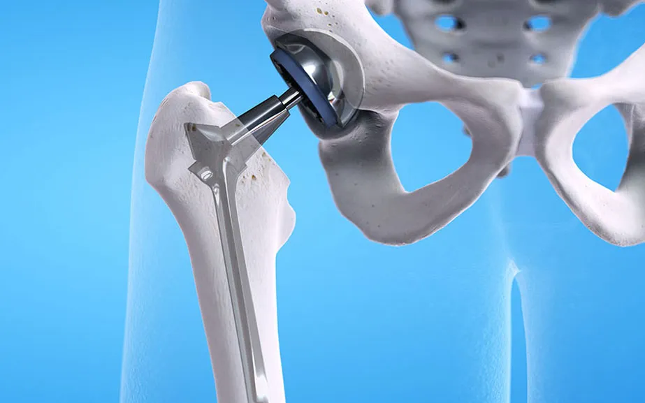 Hip Prosthesis